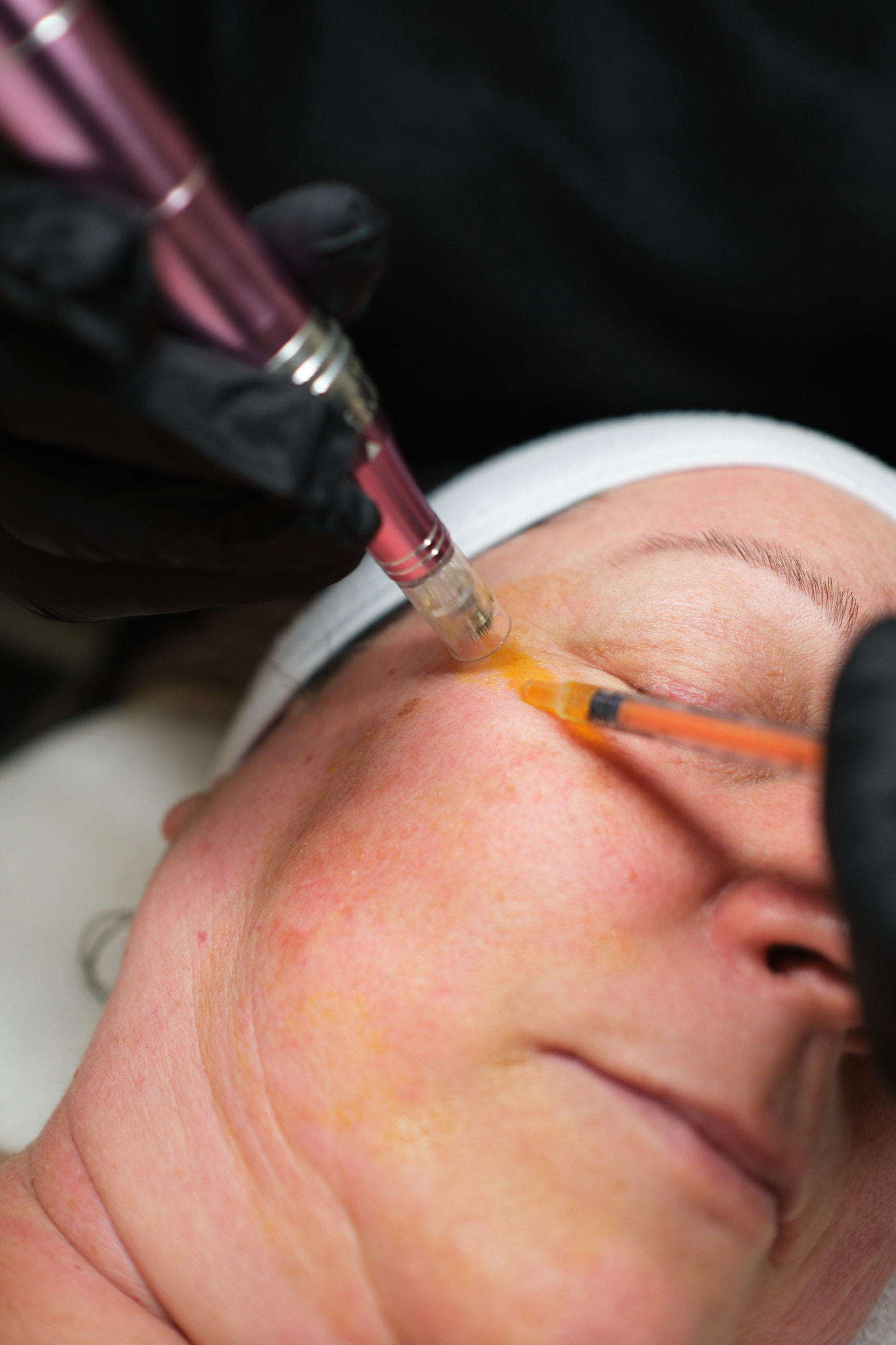 Microneedling DC