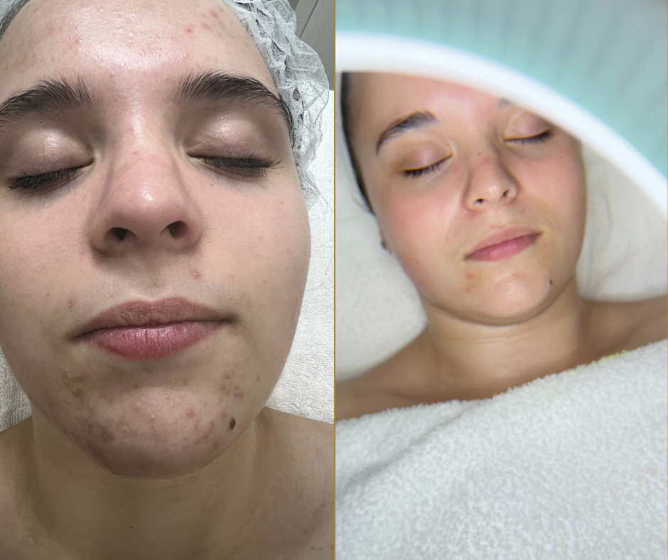 TRATAMIENTO ANTI - ACNÉ